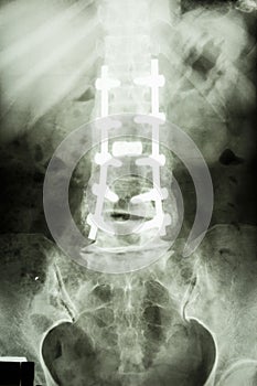 Lumbar spine with pedicle fixation photo