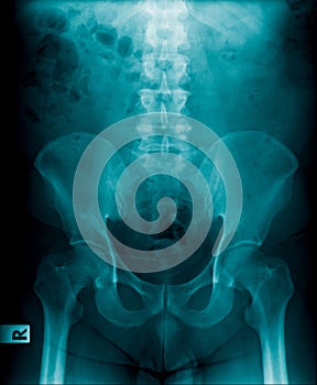 Lumbar spine x-ray image