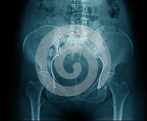 Lumbar spine x-ray image