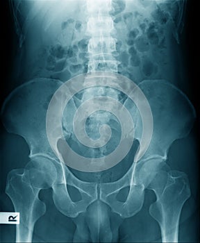 Lumbar spine x-ray image