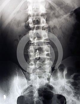 Lumbar spine x-ray, lower back