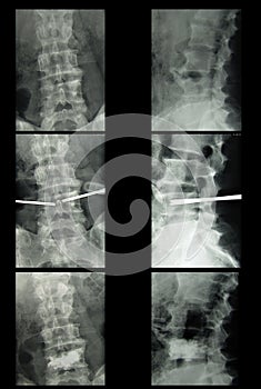 Lumbar spine x-ray, osteoporotic spine