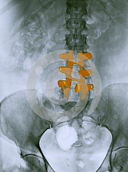 Lumbar spine x-ray showing a spinal fusion