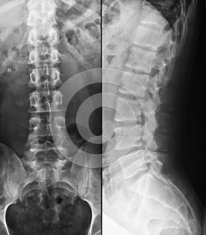 Lumbar spine X-Ray with slight s-shaped skoliosis