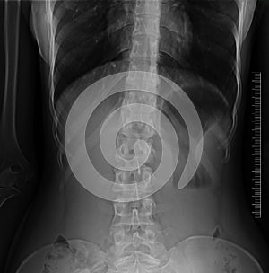 Lumbar spine x-ray photo