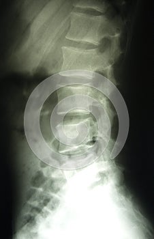 Lumbar spine x-ray, lower back