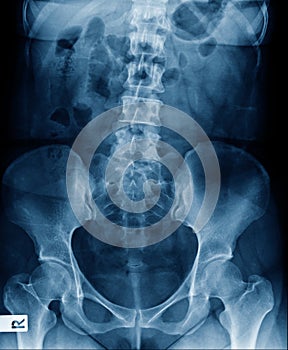 Lumbar spondylosis x-ray image