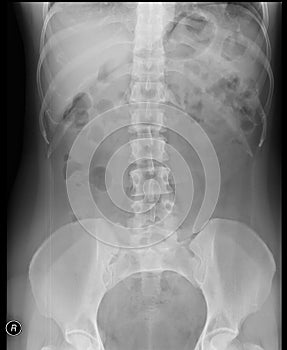 Lumbosacral spine x-ray. Anteroposterior view. photo