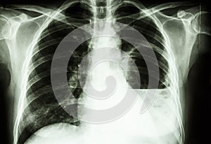 Lung abscess photo