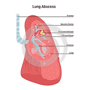 Lung abscess. Microbial infection of the lung causing necrosis of the pulmonary