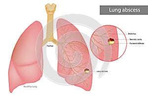 Lung abscess is a type of liquefactive necrosis of the lung tissue. Purulent infiltrate and Necrotic cavity in the lungs