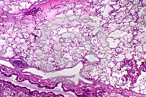 Lung adenocarcinoma