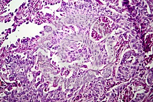 Lung adenocarcinoma, light micrograph