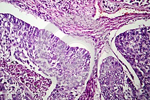 Lung adenocarcinoma, light micrograph