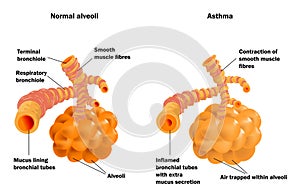Plíce alveoly normálně a astma 