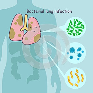 Lung with bacterial lung infection