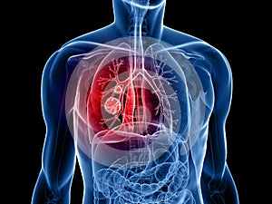 Lung cancer