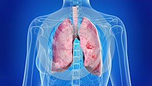 Lung cancer