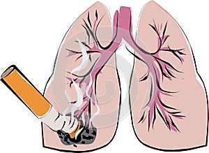 Pulmones cáncer 