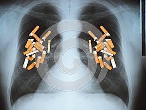 Lung cancer