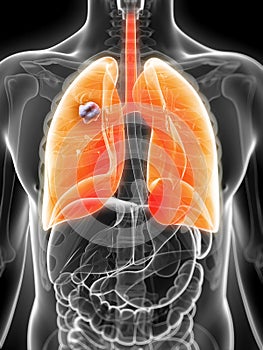 Lung - cancer