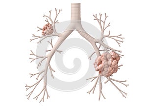 Lung cancer
