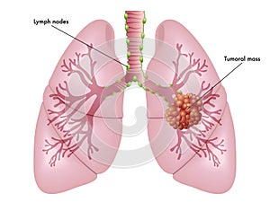 Lung cancer