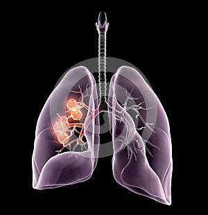 Lung cancer or bronchial carcinoma, 3D medically illustration on black background