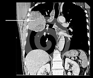 Lung cancer. Computer tomography reconstruction. photo