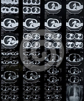 Lung cancer:CT image of chest