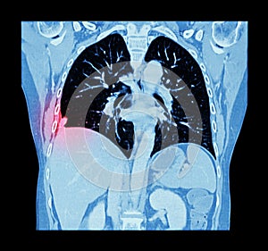 Lung cancer ( CT scan of chest and abdomen : show right lung cancer ) ( Coronal plane )