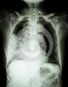 Lung cancer .Film chest x-ray show right lung mass , wide mediastinum , pneumonia and right pleural effusion photo