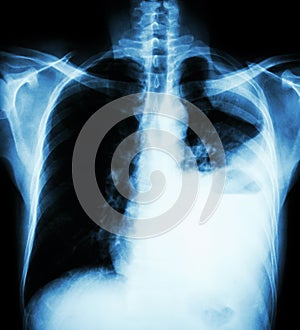 Lung cancer ( film x-ray of chest PA upright : show pleural effusion at left lung due to lung cancer ) ( 2 type of lung cancer : photo
