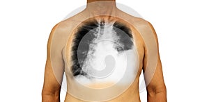 Lung cancer . Human chest and x-ray show pleural effusion left lung due to lung cancer photo