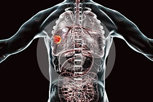 Lung cancer, illustration