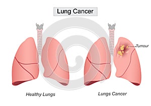 Lung cancer is a kind of cancer photo