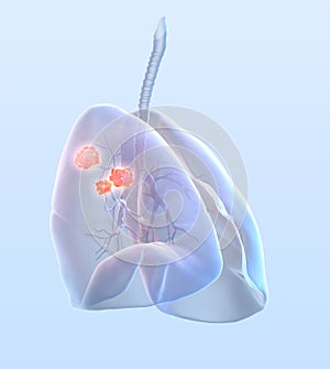 Lung cancer, medically 3D illustration photo
