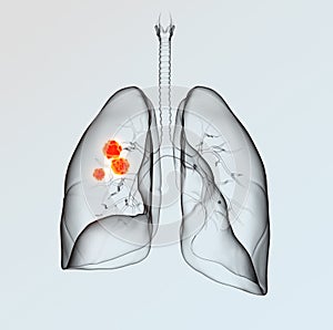 Lung cancer, medically 3D illustration on light background photo