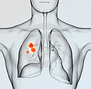 Lung cancer, medically 3D illustration on light blue background