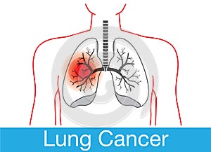 Lung cancer notification
