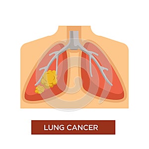 Lung cancer oncology and tumor disease or illness