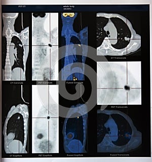 Lung cancer:PET-CT image of chest