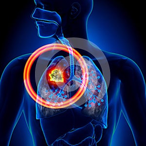 Lung Cancer - Tumor