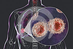 Lung cancer tumor and close-up view of malignant cells, 3D illustration