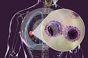 Lung cancer tumor and close-up view of malignant cells, 3D illustration