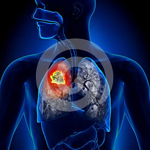 Lung Cancer - Tumor photo