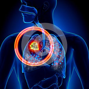 Lung Cancer - Tumor photo