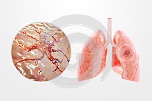 Lung cancer, tumor, human anatomy, disease. Concept of health care, medicine, biology. 3D render, 3D illustration, copy space, photo