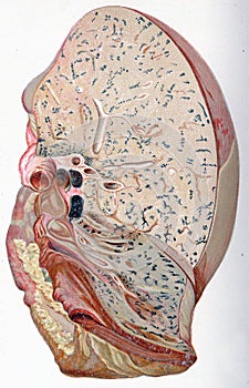 Lung, croupous pneumonia, vintage engraving photo