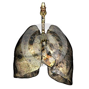 Pulmones enfermedad 